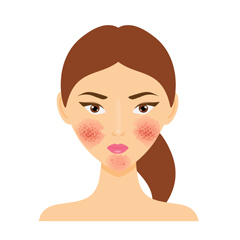 ISSalute_it's tweet image. Alcuni consigli utili per prevenire la formazione dell’acne rosacea puoi trovarli qui 👉 ow.ly/987o50MHLL8  #acne #rossore #esposizione #sole #salute #ISSalute