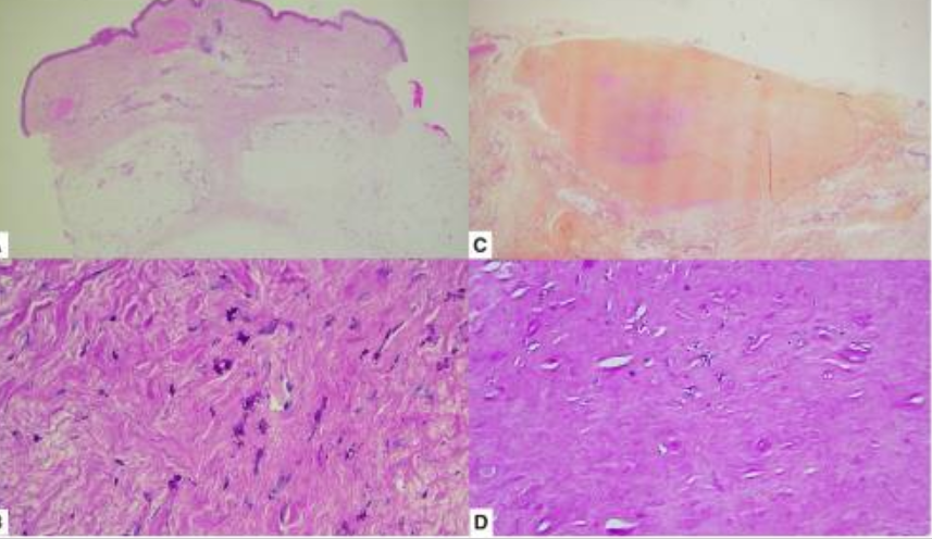 65yo♂️18yrs"+RA"nodule olecran knee
5yrs episodic🤒🤒bloatg breathless 7kg⬇️
LFL MTX INF ADA ETN ABA TLZ Jak🚫
Still? ANA1x, upadac🚫 sarilum〰️
🆕fec Calprot⬆️
🔑🤔
PCR multip:Troph wh
🔬+nodule 🔬🔬🔬typic
◾Whipple c/ pseudorheu nodule
💊Doxy HCQ😀😀
ncbi.nlm.nih.gov/pmc/articles/P…