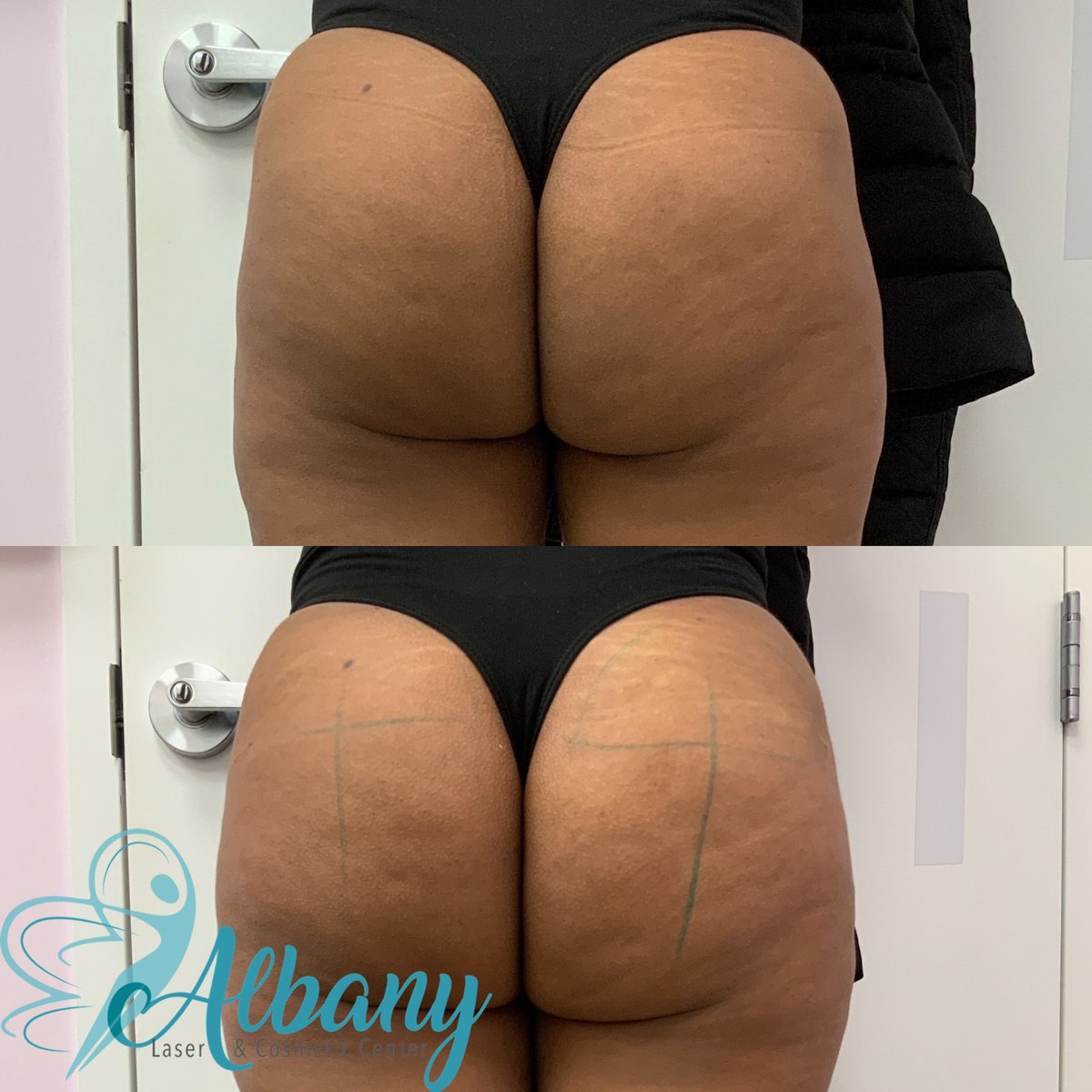Feeling bootylicious and confident like never before! 🍑 Thanks to the magic of non-surgical Brazilian Butt Lift, the patient now have the curves she always dreamed of. #bootygoals #nonsurgicalbbl #selflove #confidenceboost
albanylaser.ca/services/brazi…