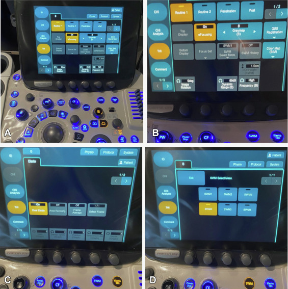 Online now in GIE’s Articles in Press: “Top tips in EUS elastography (with videos)” by Scot M. Lewey. giejournal.org/article/S0016-…

<a href="/EUSandEndoscopy/">Scot Michael Lewey</a>