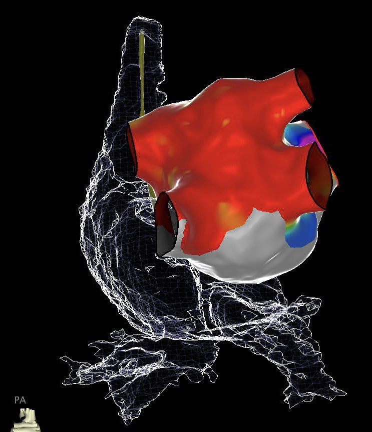 Xiaodong Zhang (Andy), MD, PhD, FHRS, FACC (@andyzhangmd) on Twitter photo Most difficult PVI+PWI ever! 56 y, F, AF, dextrocardia with IVC interruption, s/p remote surgical ASD repair, DC-PPM, failed DCCV*2. Thanks for all the supports! #Epeeps <a href="/LuigiDiBiaseMD/">Luigi Di Biase</a> <a href="/NilarunC/">Nilarun Chowdhuri</a> <a href="/GrupposoVito/">Vito Grupposo</a> <a href="/danpugliesemd/">Dr. Dan</a> <a href="/VelascoCardio/">Alejandro Velasco MD</a> <a href="/MonteHeart/">Montefiore Heart</a> <a href="/MontefioreNYC/">Montefiore Health System</a> <a href="/EinsteinMed/">Albert Einstein College of Medicine - Official</a> Most difficult PVI+PWI ever! 56 y, F, AF, dextrocardia with IVC interruption, s/p remote surgical ASD repair, DC-PPM, failed DCCV*2. Thanks for all the supports! #Epeeps <a href="/LuigiDiBiaseMD/">Luigi Di Biase</a> <a href="/NilarunC/">Nilarun Chowdhuri</a> <a href="/GrupposoVito/">Vito Grupposo</a> <a href="/danpugliesemd/">Dr. Dan</a> <a href="/VelascoCardio/">Alejandro Velasco MD</a> <a href="/MonteHeart/">Montefiore Heart</a> <a href="/MontefioreNYC/">Montefiore Health System</a> <a href="/EinsteinMed/">Albert Einstein College of Medicine - Official</a>