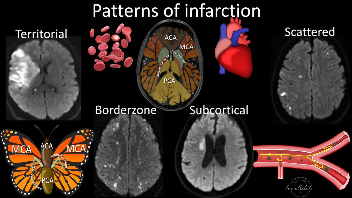 1/I always tell my fellows, “Anyone can see the bright spot on diffusion—what sets you apart is if you can tell them why it’s there!” Can you tell a stroke’s etiology from its appearance on MRI? Here’s a #tweetorial to show you how! #medtwitter #neurotwitter #stroke #neurorad