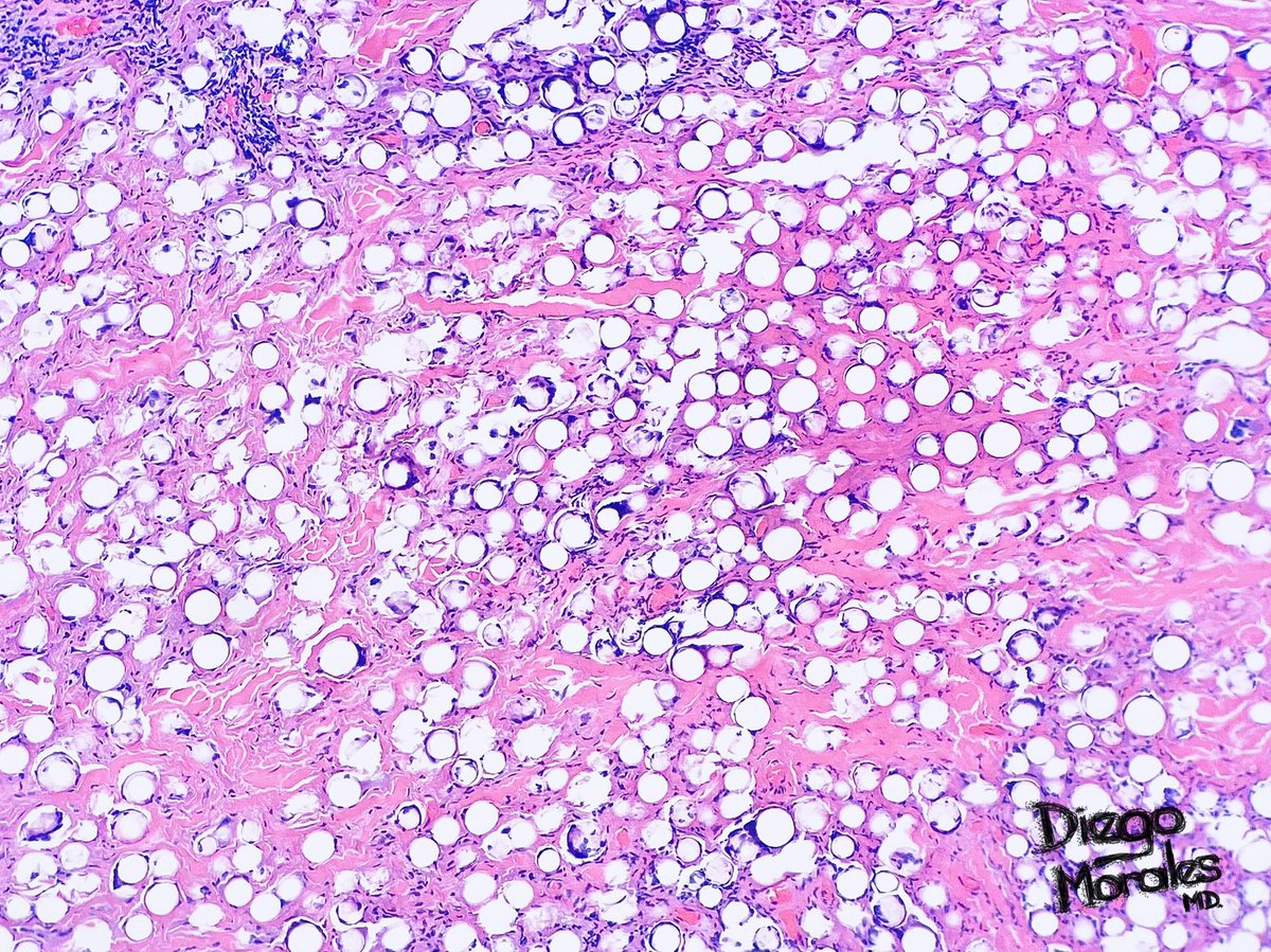 DiegoMoralesN's tweet photo. #PathTwitter do you know what this is?
🐮's collagen + Plexiglass. A “Boba tea” for the skin https://t.co/D1OMVNEewk
#dermpath #JoyForMorfology #FreudeAnDerMorphologie #histobeauty #pathfulness #pathology #reallifedermpath https://t.co/PDpJ4qaKbg