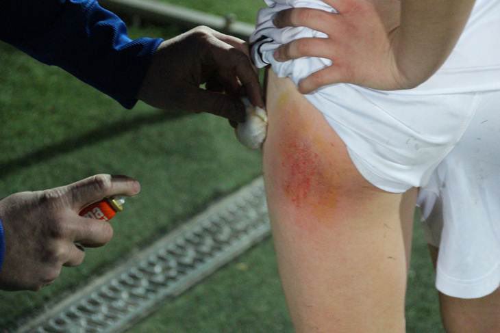 Quemadura muslo. Esa ducha post partido en la que te das cuenta de que no vas a tener una semana fácil. La marca perenne de quien tacklea de septiembre a junio. La ropa pegada a la carne viva con el liquidillo que has supurado. Pensar que, aun así, el palo diste mereció la pena.