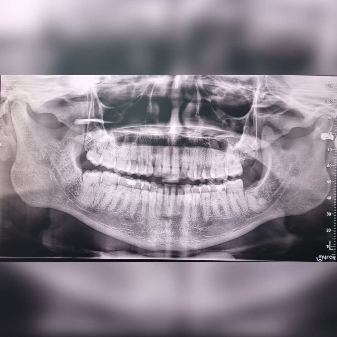 CaredentDental's tweet photo. One of our most frequently asked questions is, "Why do I need an x-ray?". We have explained this. Just click the link in our bio to get the simple answer.
https://t.co/8WJfMdVBrg
Dentistry with Heart ❤️
#dentalxrays #radiographs #dentalfaq #dentalblogs #dentistinlekkiphase1 https://t.co/oFirnEKFMo