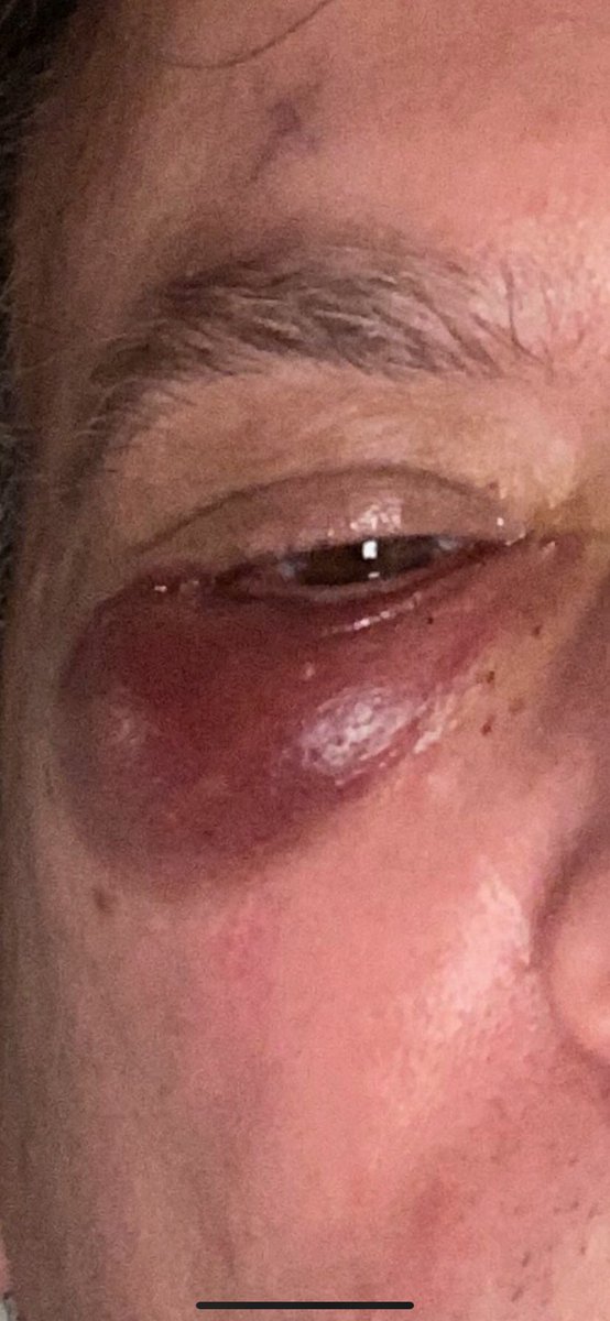 I had the 2 vaccines only as it was mandated to work, I didn’t want them, nor the business to fail &amp; employees lose jobs, I held out to the last day. I’ve been in bad shape for 7 mths with a serious eye muscle injury, thyroid infection &amp; etc. It’s been confirmed it was the jabs!