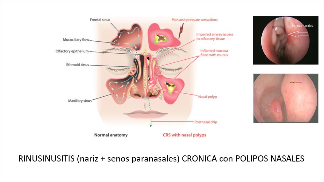 farmaciahun's tweet photo. Formándonos en Otorrino, especialidad hasta ahora desconocida en los SFH, con la sesión sobre rinosinusitis crónica con poliposis nasal y sus futuros tratamientos, impartida por nuestra compañera Esther Lacalle @elacallef @farmaciahun https://t.co/l462MYGfOi