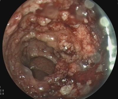 sapdes's tweet photo. 👨🏼‍🦳73 años que acude con cuadro de diarrea acuosa grave 💦💩 con hipotensión mantenida⏬⏬ y acidosis metabólica. En analítica destaca hipoK e hipoNa, función renal 👌🏼 #casoSAPD 

Se realiza colonoscopia 🧐: https://t.co/gnTl4NxzIV