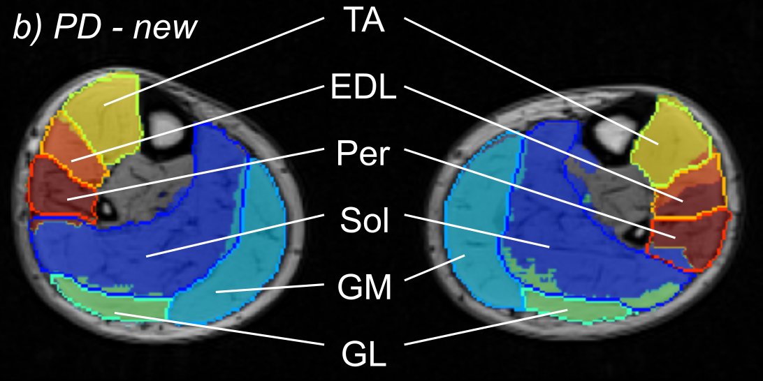 🚨 New paper uploaded to arXiv! 🚨 
Medical image segmentation is better together! #Dafne is the first #opensource, decentralized, collaborative solution for deep-learning-based segmentation that everybody can use. 🧵 #MachineLearning #MedicalImaging 

🔗 arxiv.org/abs/2302.06352