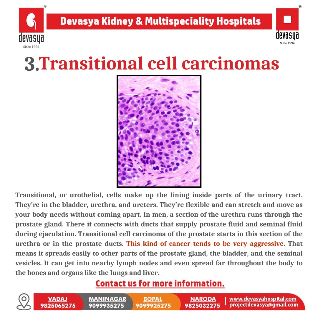 KidneyHospital's tweet photo. In the prostate cancer transitional cell carcinomas is the third type of prostate cancer. These cells are able to change shape and stretch without breaking and are found in your urinary tract for more information contact us soon.

Visit our website : https://t.co/sDMGKW2w9e https://t.co/xoPEinlFpT