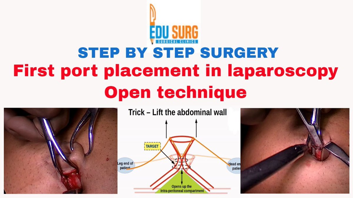 First Port Placement - Port Placement In Minimally Invasive #Surgery - #Laparoscopic Surgery Steps. Click here to watch the full video:youtu.be/ZdDzhowuu4k

#PortPlacement #MinimallyInvasiveSurgery #LaparoscopicSurgery #medicalstudent #dr #learning #EdusurgClinics