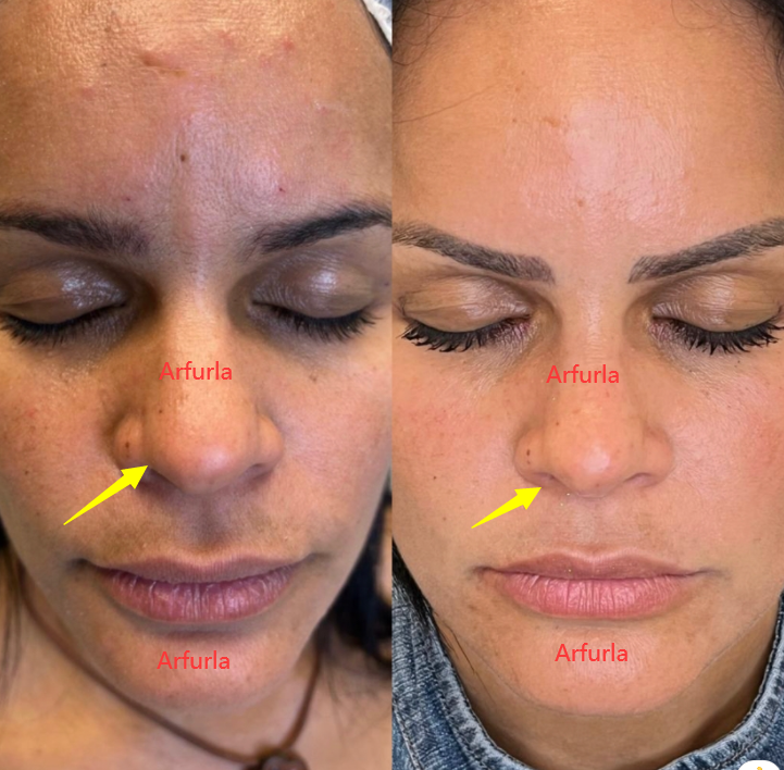 Jason_arfurla's tweet photo. #loseweight #beautysalon #lasertechnology #papada #lipopapada #facelift #plasticsurgeon #laserclinic #endolift #plasticsurgery #liposuction #facelifting #diodelaser #arfurlaser #skintightening #skinrejuvenation #facelift #faciallifting #liposuctiondevice #liposuctionequipment https://t.co/K9Qtb4H41p