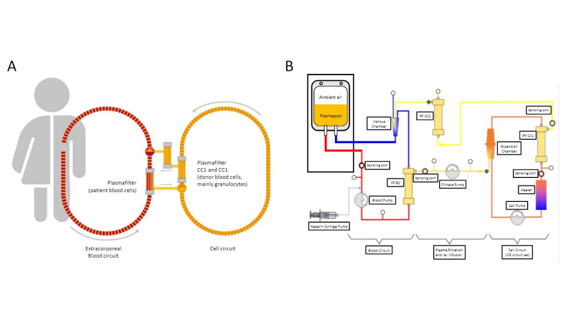ArtifOrgans's tweet photo. #Extracorporeal therapy of #Sepsis by purified granulocyte concentrates - #ExVivo circulation model
👉https://t.co/8RADwtuojY
@Unirostock🇩🇪| @GKlinkmann #ClinicalUse https://t.co/vQnWYH79Bs