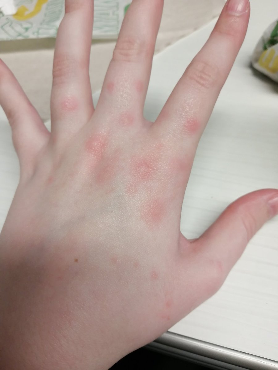 ((I have hives all over and stuck in a 4 hour lay over lol. RIP
