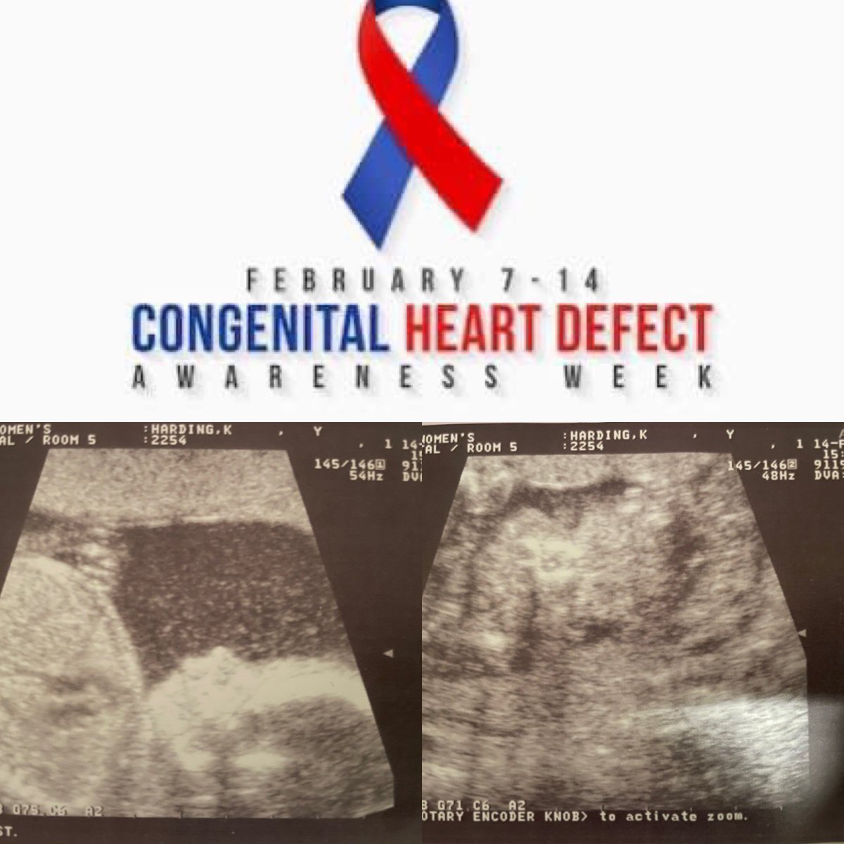 Kailen’s heart defect was detected at our 20 week ultrasound at Women’s. It was Feb. 14th, 2006, Valentines Day. We returned every month for more imaging. Before he was born they knew he had Transposition of the Great Arteries. <a href="/Childrens_Heart/">childrens_heart</a> #CHDAwarenessWeek