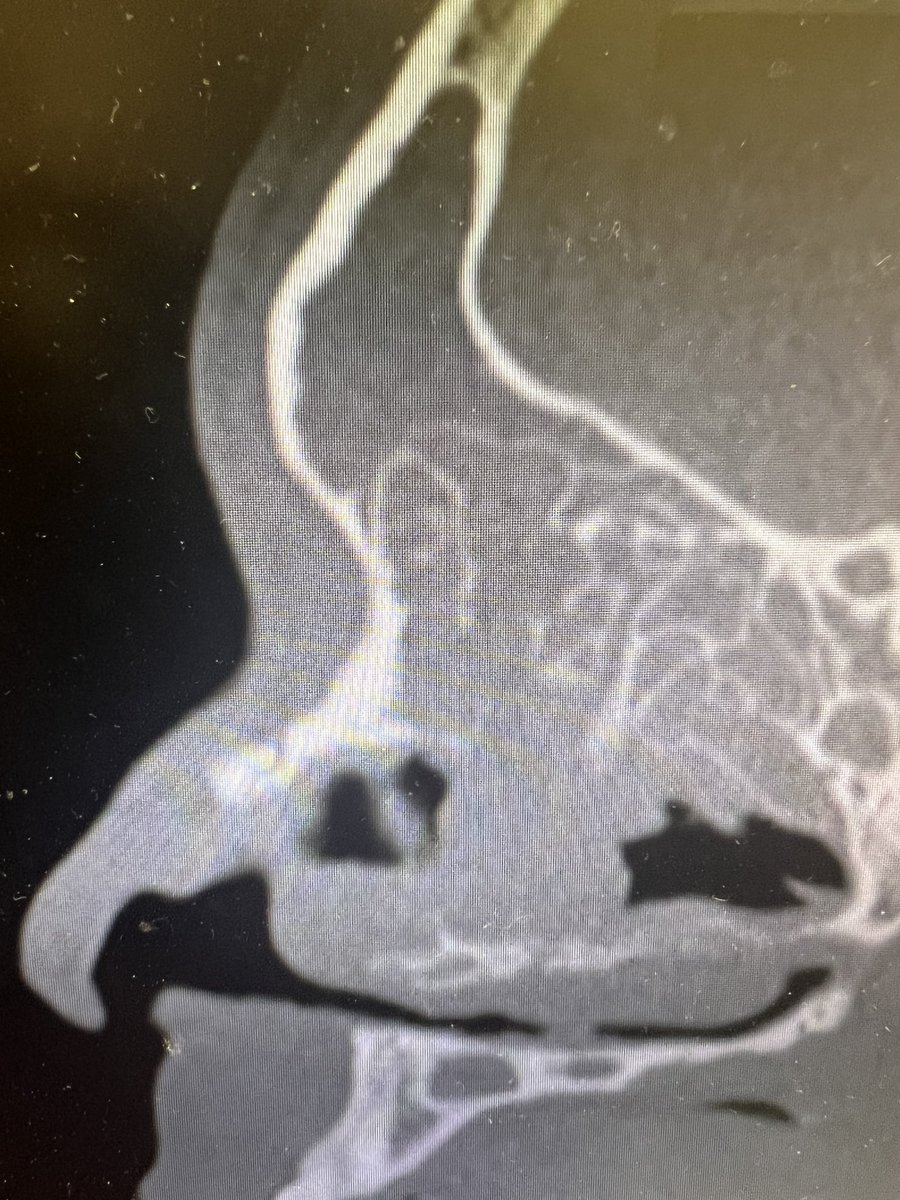 John Craig, MD (@johncraignose) on Twitter photo If you can’t keep this frontal sinus open, just hand in your rhinologist card…👃🏼 🏷️<a href="/henryfordent/">Henry Ford ENT</a> #medtwitter If you can’t keep this frontal sinus open, just hand in your rhinologist card…👃🏼 🏷️<a href="/henryfordent/">Henry Ford ENT</a> #medtwitter