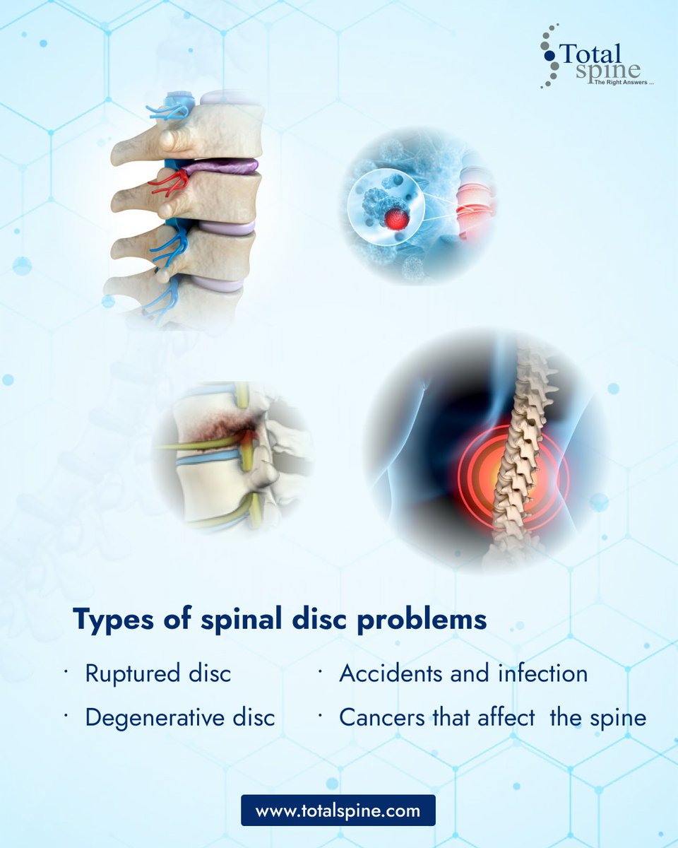 TotalSpine_in's tweet image. know your disc problems. total spine could help you recover from every kind of disc problems.
.
.
.
#spinaldisc #spine #backpain #neckpain #wellness #healthylifestyle #scoliosis #pain #spinehealth #posture #painrelief  #doctor #surgery #cancer #orthopedics #kneepain #spinesurgeon