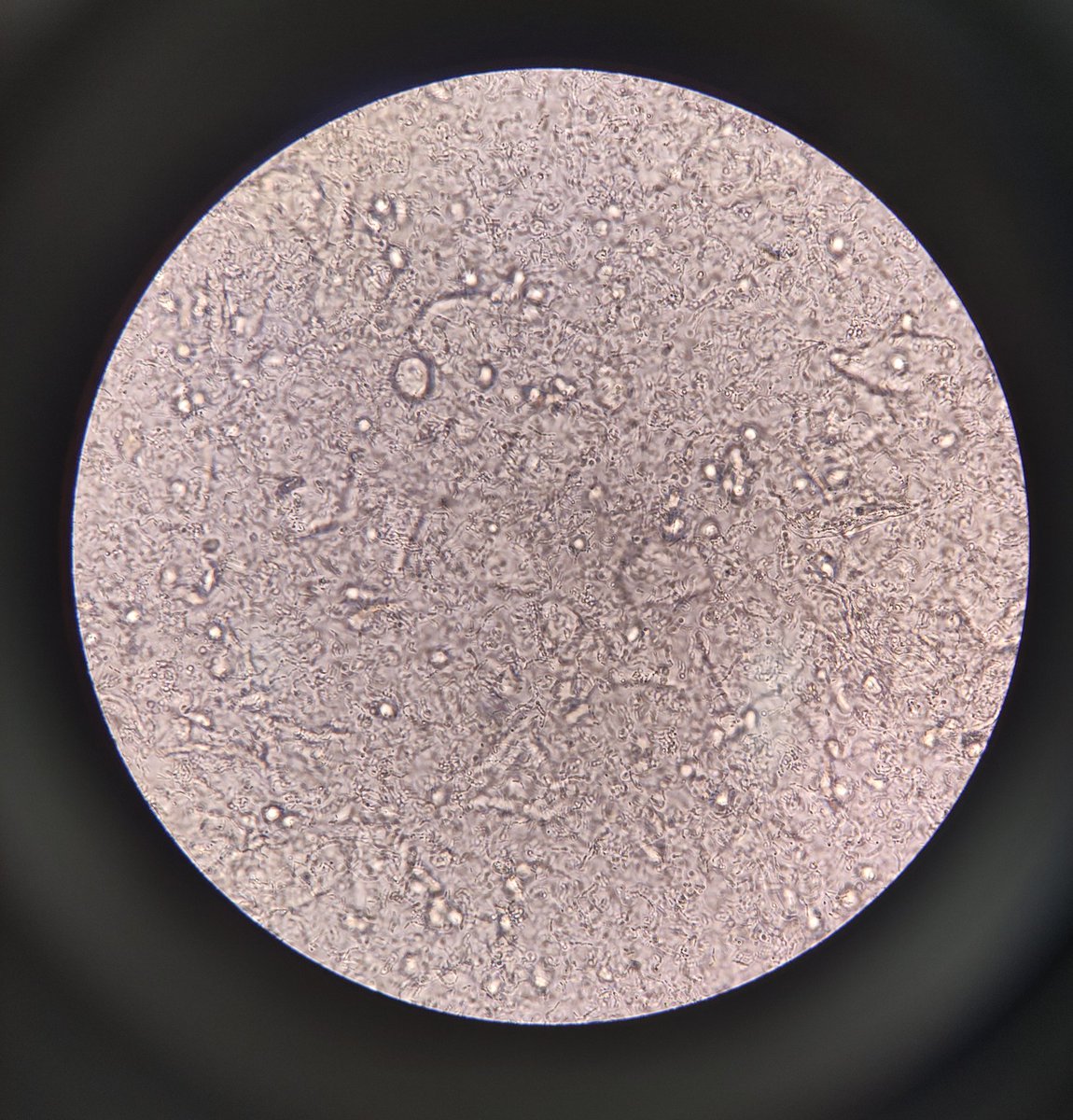 medtechlyfe's tweet photo. You saw this during examination of a urine sample! Anong reportable constituents ang present? (No need to rate yet, ano lang yung nakita niyo). And what possible condition causes this? 👩🏻🔬🔬 #ClinicalMicroscopy #Urinalysis #Medtwt #MedtechTwt #StudyTwt #RMTSoon 🤓 https://t.co/e15BMVCGIj