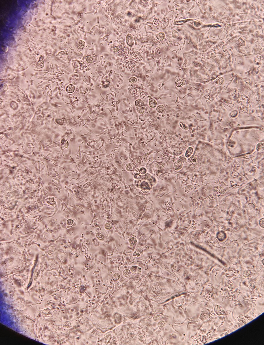 medtechlyfe's tweet photo. You saw this during examination of a urine sample! Anong reportable constituents ang present? (No need to rate yet, ano lang yung nakita niyo). And what possible condition causes this? 👩🏻🔬🔬 #ClinicalMicroscopy #Urinalysis #Medtwt #MedtechTwt #StudyTwt #RMTSoon 🤓 https://t.co/e15BMVCGIj