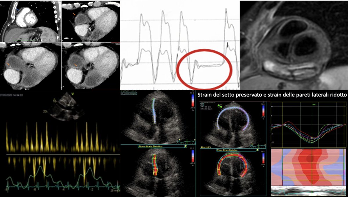 Giornale Italiano di Cardiologia (@gitalcardiol) on Twitter photo Sospetto di pericardite costrittiva: quali metodiche di imaging impiegare per giungere a questa diagnosi? ๐๐๐ Non perdere la rubrica di imaging cardiaco integrato online di Sirugo, Tonet & <a href="/GianlucaCampo78/">Gianluca Campo</a>
giornaledicardiologia.it/archivio/3963/โฆ Sospetto di pericardite costrittiva: quali metodiche di imaging impiegare per giungere a questa diagnosi? ๐๐๐ Non perdere la rubrica di imaging cardiaco integrato online di Sirugo, Tonet & <a href="/GianlucaCampo78/">Gianluca Campo</a>
giornaledicardiologia.it/archivio/3963/โฆ