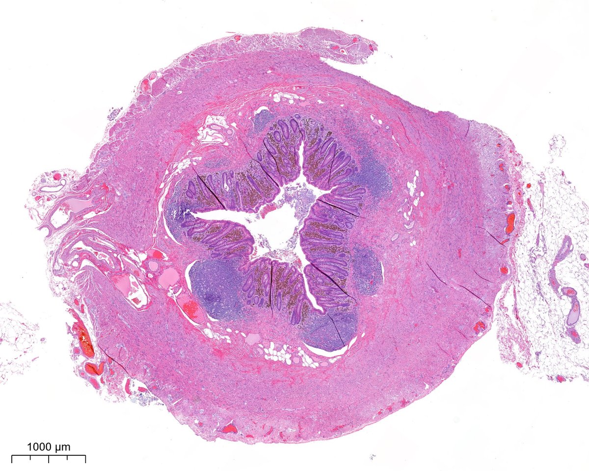 PoloniaAntonio's tweet photo. A classic in the #GIpath, this time in the appendix 😃@atman_ci @DrGeeONE @A_Morini_MD @ariella8 @nusrat_xahra @miss_me1986 @gonzadetoro @TristanRutland7 @GIJamesMD @LoboAnandi @SumantaDas_7 @kis_lorand @DraEosina @nucleololailo @joaquinnieves55 @padmapathology1 @DrBMcGinn https://t.co/Q53x6IO3Uv