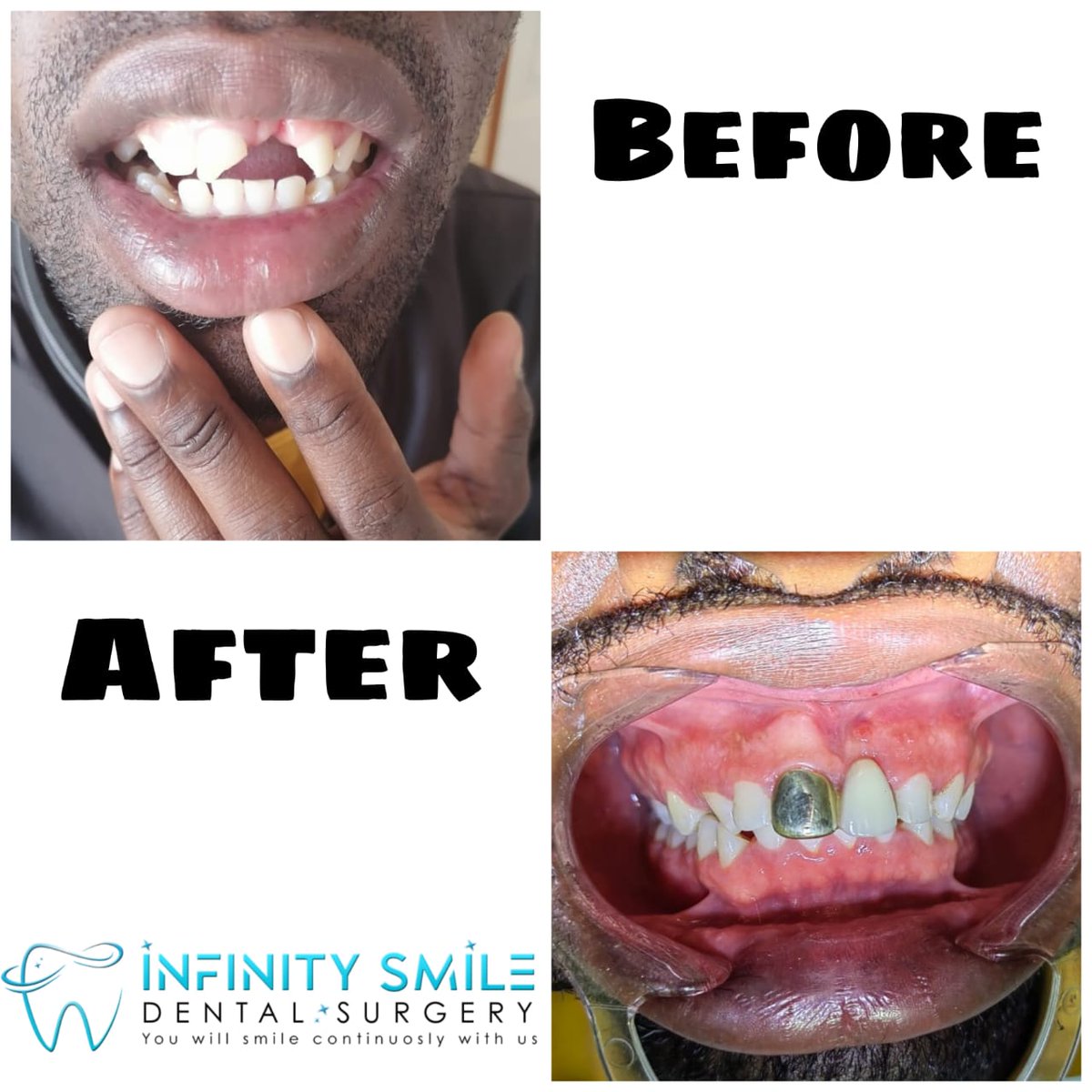 smile_surgery's tweet photo. Let us fix your missing teeth with a permanent solution...
#dentalbridge #dentalhealth #dentalcare #missingteeth #crownandbridgework #infinitysmiledentalsurgery #infinitysmile https://t.co/XsASHr3zqX