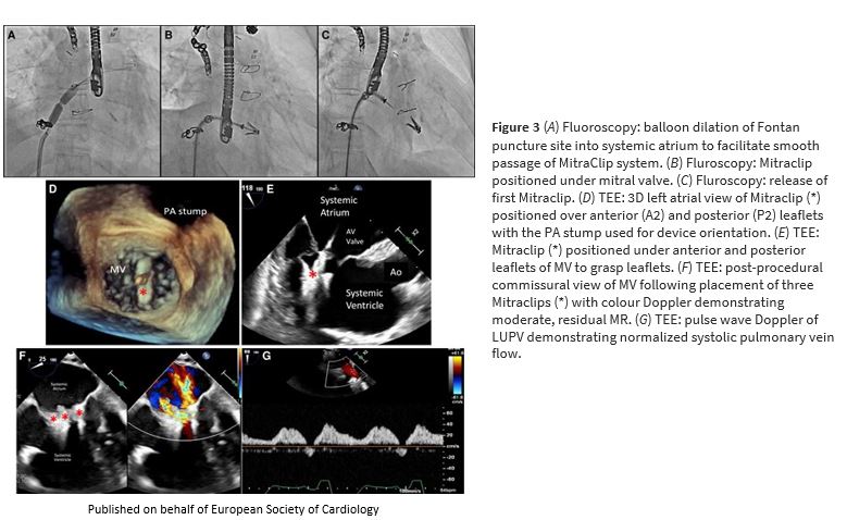 ESC_Journals's tweet photo. #FirstInMan: mTEER in an adult extracardiac Fontan patient https://t.co/MvbHwEf0WS

#EHJCaseReports #YesCCT #ImageFirst #RadialFirst @KardiologieHH @aayshacader @ANazmiCalik @EHJCREiC @TJ_Yeo @cfcamm @FarhanaAra @HikmetKadi https://t.co/wwH8MhevHL