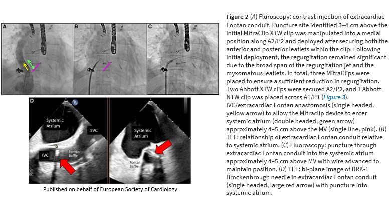 ESC_Journals's tweet photo. #FirstInMan: mTEER in an adult extracardiac Fontan patient https://t.co/MvbHwEf0WS

#EHJCaseReports #YesCCT #ImageFirst #RadialFirst @KardiologieHH @aayshacader @ANazmiCalik @EHJCREiC @TJ_Yeo @cfcamm @FarhanaAra @HikmetKadi https://t.co/wwH8MhevHL
