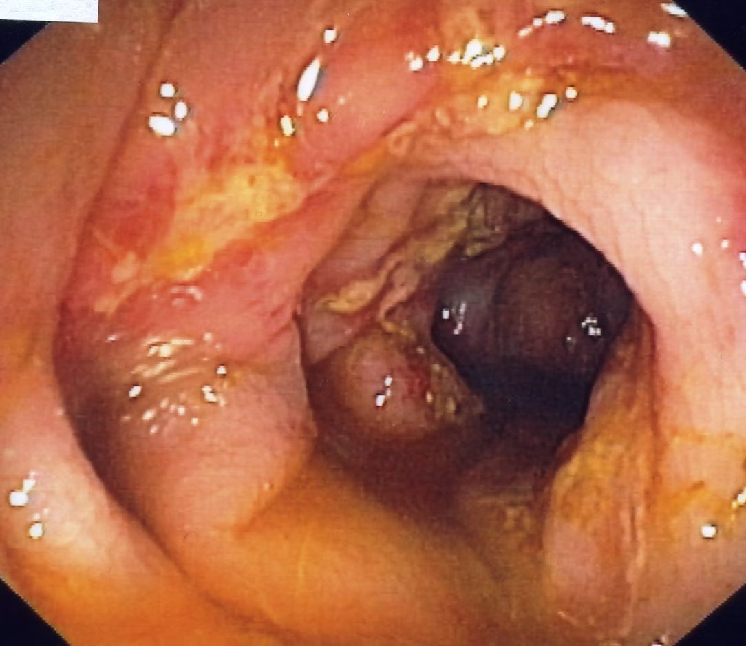 EndoCollab™ | GI Endoscopy Community tweet media