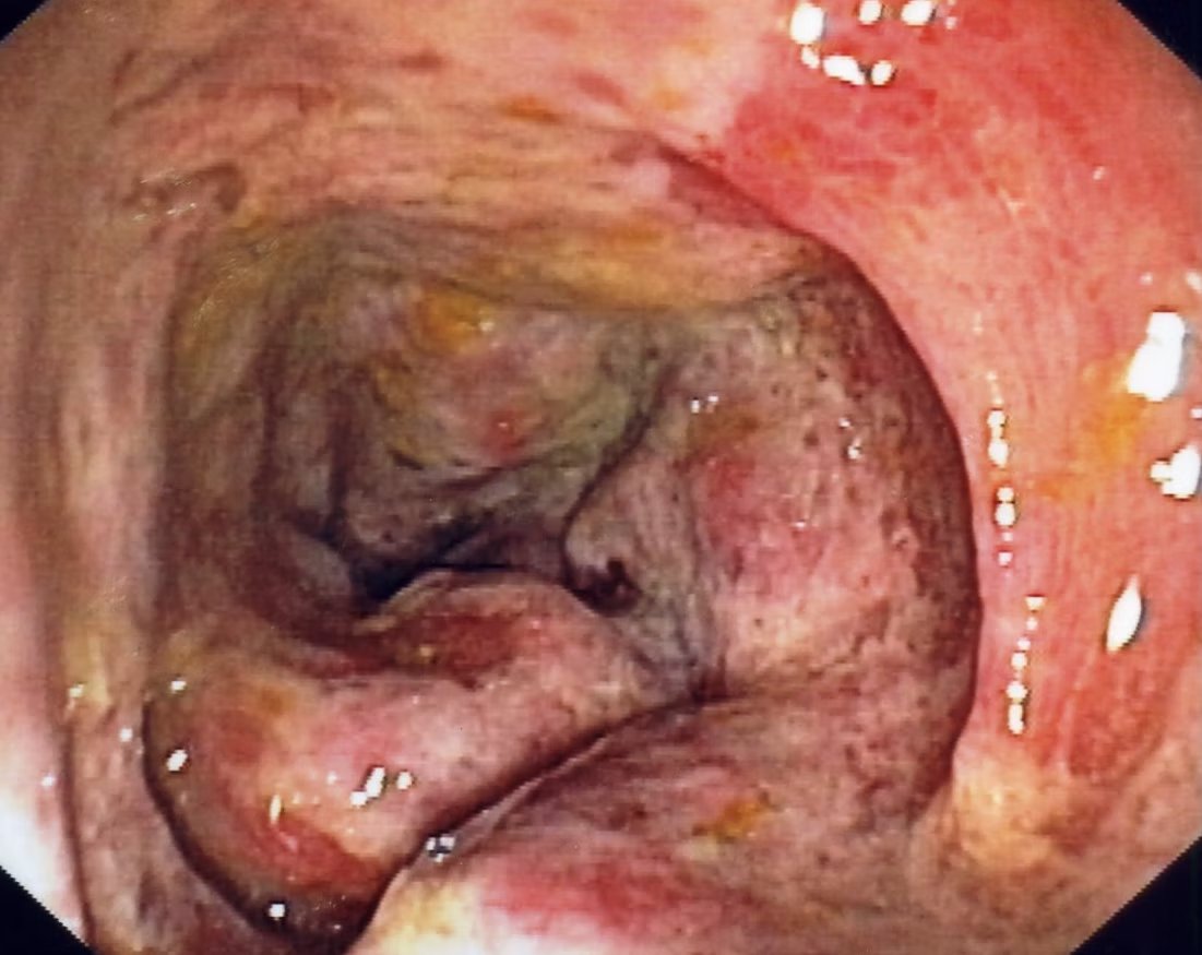 EndoCollab™ | GI Endoscopy Community tweet media