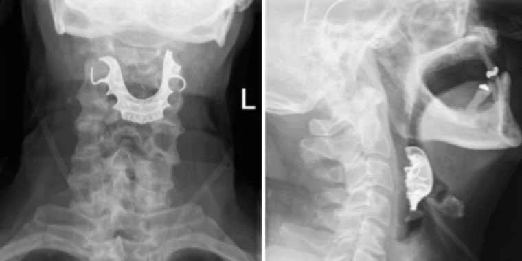 XrayProblems's tweet photo. The search for the missing dentures 🦷🦷🦷 #xrayprobs https://t.co/RJZVgZTI0F