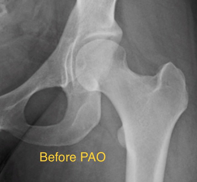 DrDerekOchiai's tweet photo. We started National Hip Center with the goal of taking a synergistic approach to complex hip conditions. This sometimes involves having multiple surgeons combining their expertise, such as in this case. @DrFarshadAdib with the open PAO, while I was lead on the #HipArthroscopy. https://t.co/kYhmb1S8zR
