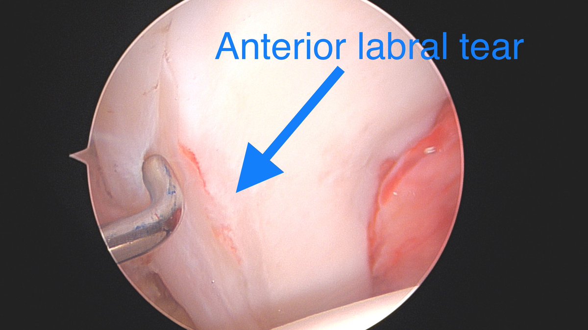 DrDerekOchiai's tweet photo. We started National Hip Center with the goal of taking a synergistic approach to complex hip conditions. This sometimes involves having multiple surgeons combining their expertise, such as in this case. @DrFarshadAdib with the open PAO, while I was lead on the #HipArthroscopy. https://t.co/kYhmb1S8zR