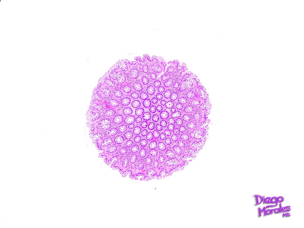 DiegoMoralesN's tweet photo. Colonic polyp.
#pathtwitter #gipath #TooPrettyNotToShare #JoyForMorphology #freudeandermorphologie https://t.co/PK3gwAxasH