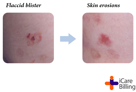 icarebilling's tweet image. Pemphigus is a disease that causes blistering of the skin and the inside of the mouth, nose, throat, eyes, and genitals. Pemphigus is an autoimmune disease in which the immune system mistakenly attacks cells in the top layer of the skin.
#iCareBilling #HealthCare #Pemphigus #care