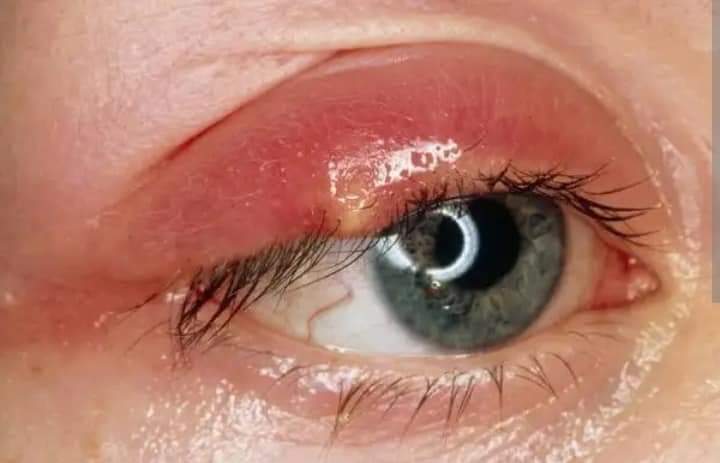 ⭕⭕آنکھ کے پاس بننے والی پھنسی :::

آنکھوں کے اردگرد گلینڈز ہوتے ہیں جن میں سے رطوبت نکلتی یے۔ 

کسی وجہ سے بلاک ہو جائے تو یہ stye نکل آتی ہے۔ اور بعض لوگوں کو بار بار نکلتی ہے۔ 

عام طور پر ایک سے تین دن میں خود بخود ختم ہو جاتی ہے۔