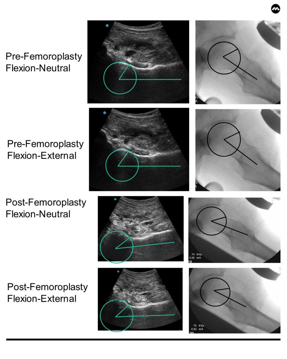 shanenhomd's tweet photo. 🚨🚨Upcoming Research🚨🚨
Our upcoming technique article in @ArthroscopyJ demonstrates #intraoperative use of #ultrasound to assess #cam #resection during #hip #arthroscopy. Be on the lookout for it!
#FAIS #femoroacetabular #impingement #NhoMoreHipPain #SaveTheLabrum @MOR_Docs https://t.co/BKFsLDf4sQ