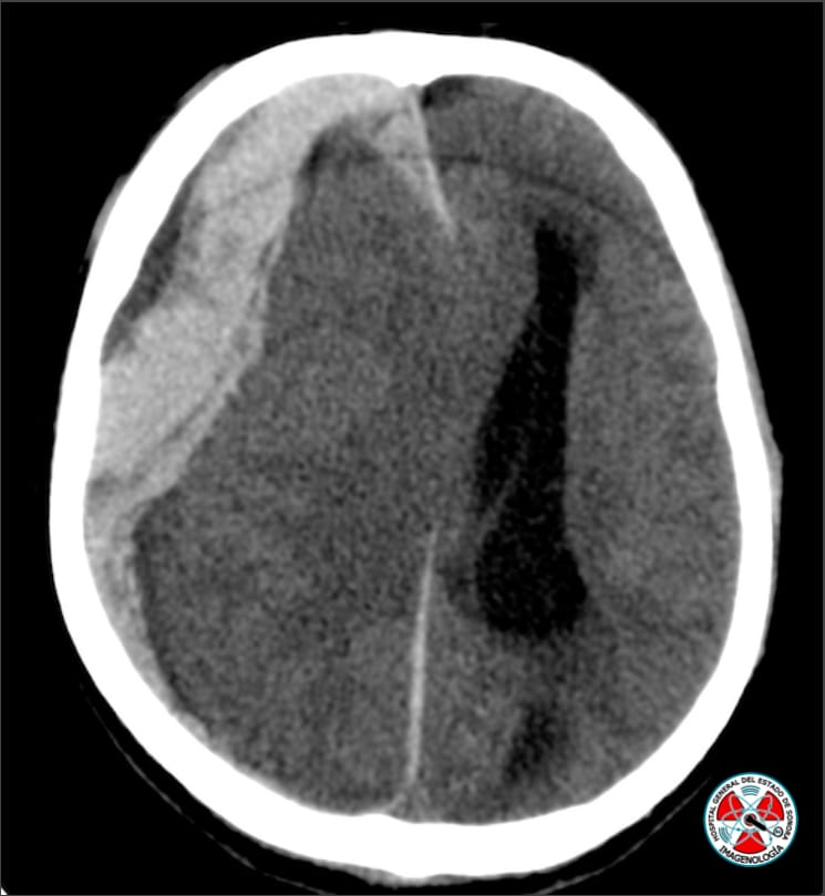 #Firstsigth  #ct #radres ¿Cuál es tu diagnóstico?
👁️
