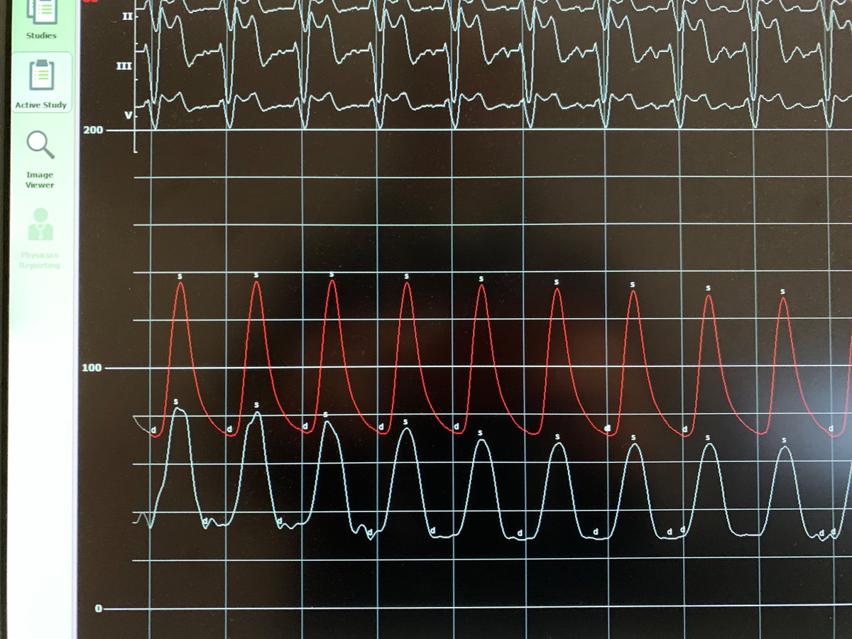 NavinKapur4's tweet photo. In this case, a little #Shock goes a long way - 9Fr #Impella ECP from @abiomed supported CABG declined LM and LAD #Shockwave with prolonged LM balloon occlusion and coronary-aortic #hemodynamic uncoupling @TuftsMedicalCtr Mind your HQ curve. Single Perclose for ECP https://t.co/5OCn1Gad99