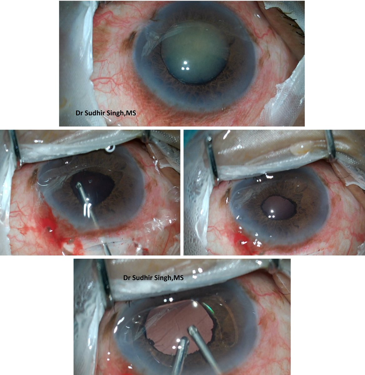 resp2020's tweet image. Management of the Anterior Dislocated Nucleus Unedited (HD)
youtube.com/watch?v=g7wGBL…

#MSICS #SICS #Cataract #Surgery #SudhirSingh #Sudhir #GlobalHospital #MOUNTABU