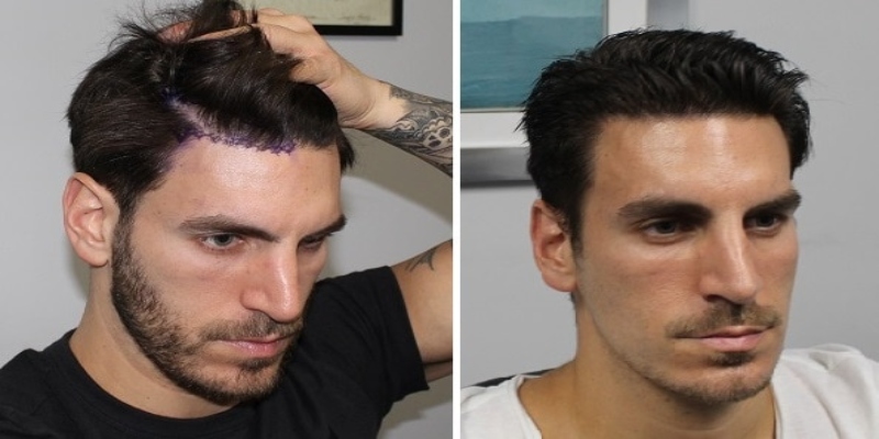 Mangosterblog's tweet image. Is It Worth It To Get A Hair Transplant? Everything You Have To Know (2022)

#hairtransplants #nonexistent #hairtransplantclinicinguwahati #mangoster

Read More: mangoster.com/hair-transplan…