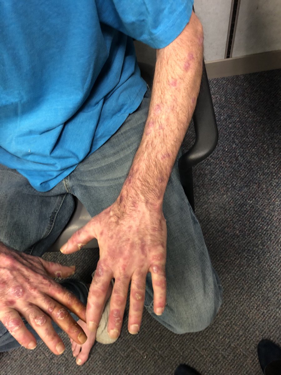 Janetbirdope's tweet photo. #RashWeek This patient stopped his #hydroxychloroquine. What #lupus rash is this? #ClinicalPearl #MedTwitter #MedEd. No hints, you have all you need for #dx! https://t.co/UAndIS3bqk
