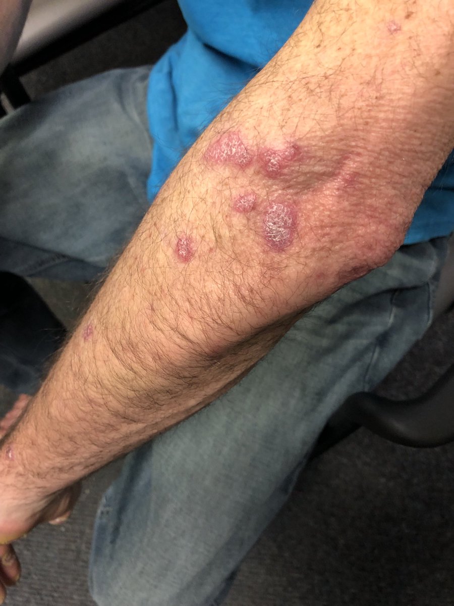 Janetbirdope's tweet photo. #RashWeek This patient stopped his #hydroxychloroquine. What #lupus rash is this? #ClinicalPearl #MedTwitter #MedEd. No hints, you have all you need for #dx! https://t.co/UAndIS3bqk