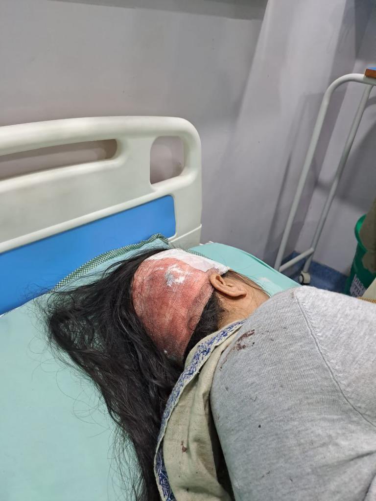 shruti_garg0104's tweet photo. Blue Baleno hit-and-run near Noida Sec 51 metro last night leaving our friend with open head wound,fighting for her life.4 hrs of brain-surgery, still unconscious.Perpetrators roam free. Authorities,please act!. @wpl1090 @CP_Noida @myogiadityanath @noidapolice  @PMOIndia https://t.co/3M5aHhjhuT