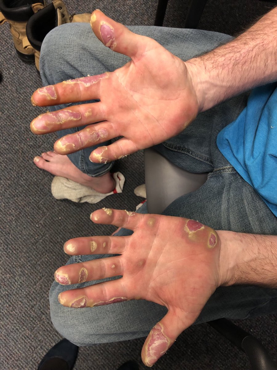 Janetbirdope's tweet photo. #RashWeek Roofer with cutaneous #lupus and new significant skin breakdown. skin is flaring but I suspect the palms and soles are unrelated. What do you think it is? #ClinicalPearl #MedEd #MedTwitter https://t.co/Z5dIA7a1oK