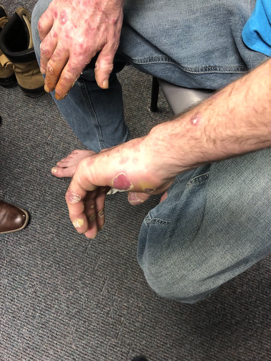 Janetbirdope's tweet photo. #RashWeek Roofer with cutaneous #lupus and new significant skin breakdown. skin is flaring but I suspect the palms and soles are unrelated. What do you think it is? #ClinicalPearl #MedEd #MedTwitter https://t.co/Z5dIA7a1oK
