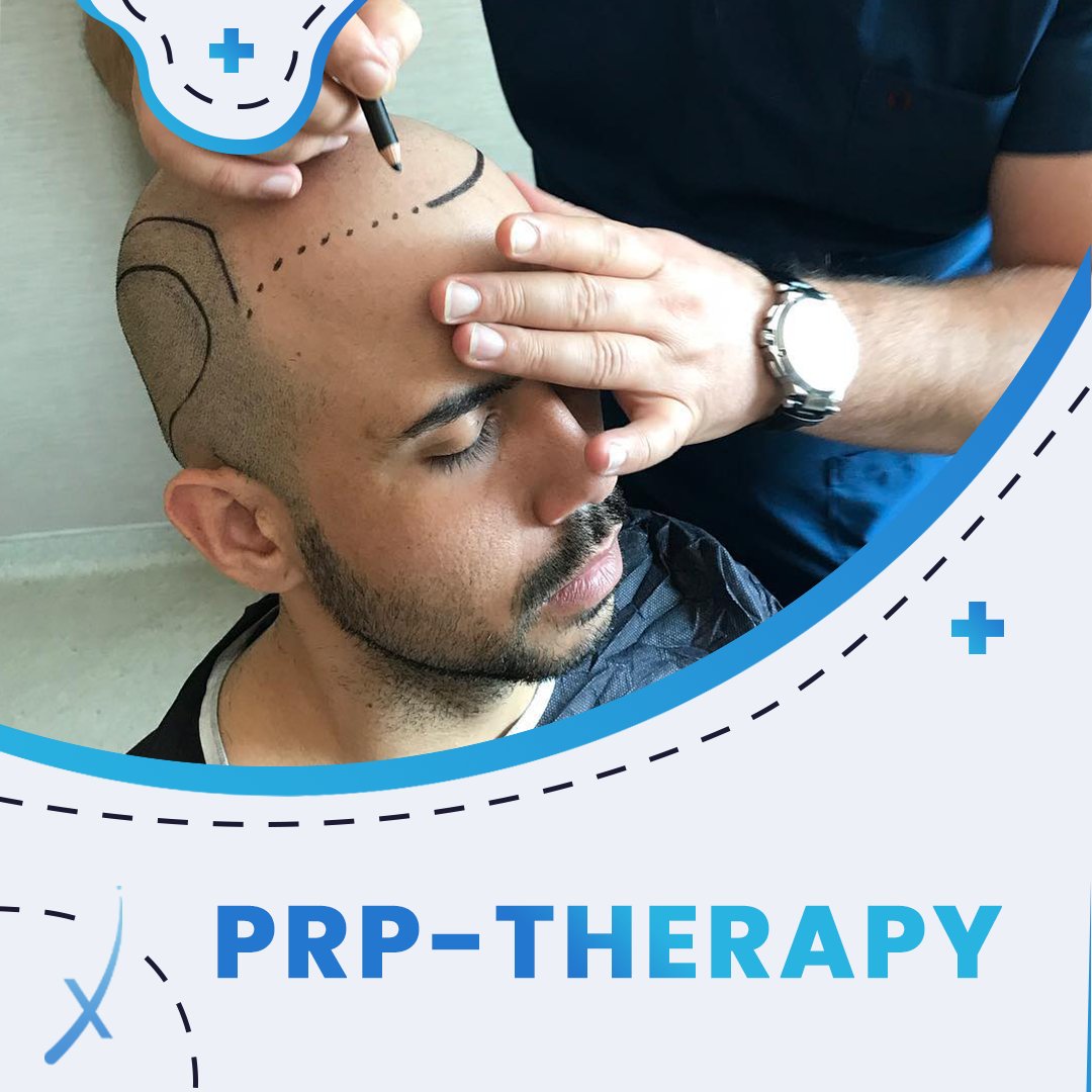 This is an immunostimulatory treatment that significantly improves donor graft engraftment and stimulates all hair follicles. PRP therapy is effective not only during but also after transplantation. 
#hairtransplantation#hairtransplantationincancun#hairinmexico#clinicinmexico