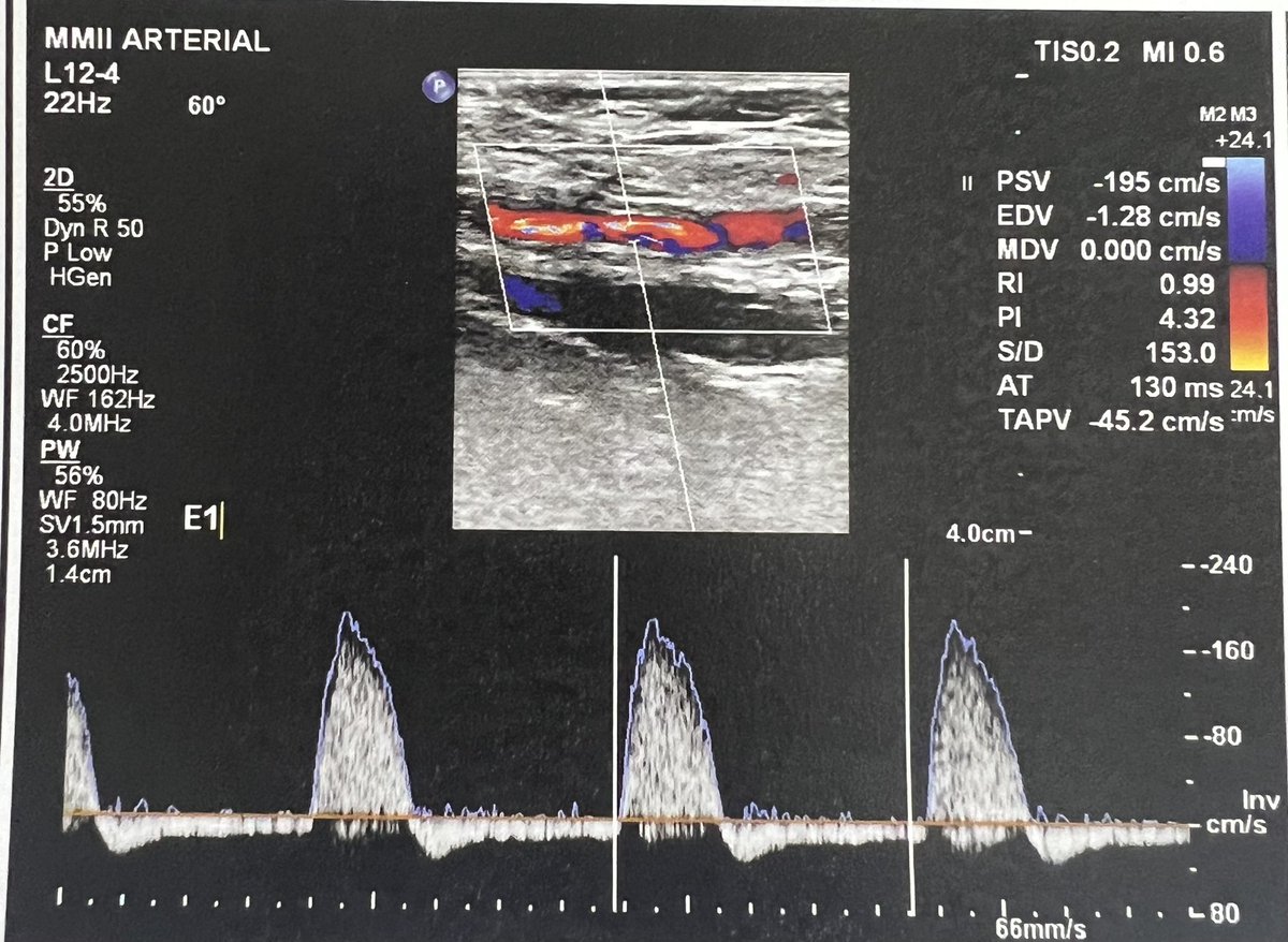 ChaconMatoso's tweet photo. 72 y/o,female, hypertensive, diabetic, with coronary disease, with femoro-popliteal bypass with great saphenous vein 2 years ago, evolving with Doppler surveillance changes and ABI drop.  performed angioplasty with drug balloon  (Stellarex). #endovascular #bypass https://t.co/pc8iTbsTFH