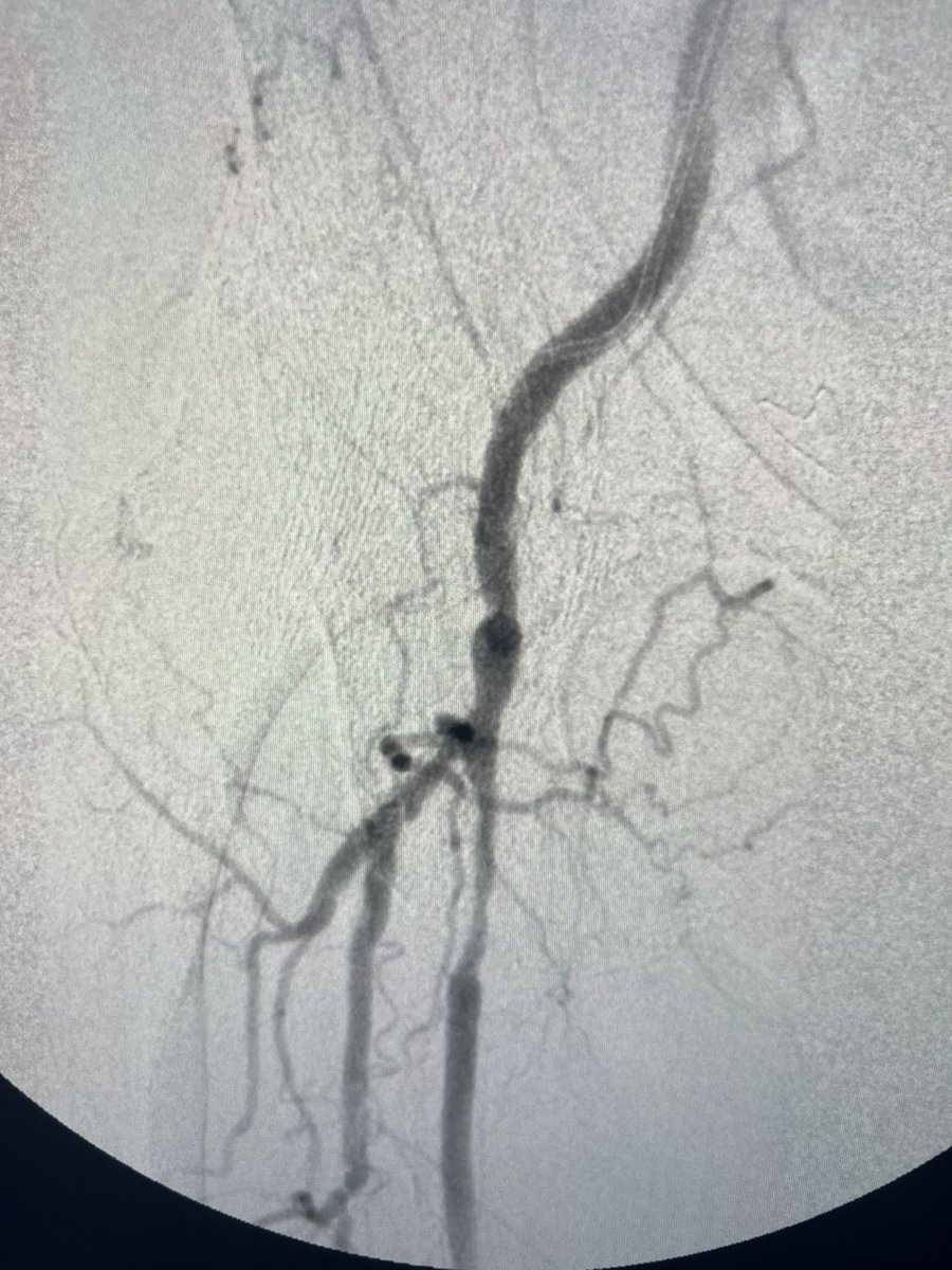 ChaconMatoso's tweet photo. 72 y/o,female, hypertensive, diabetic, with coronary disease, with femoro-popliteal bypass with great saphenous vein 2 years ago, evolving with Doppler surveillance changes and ABI drop.  performed angioplasty with drug balloon  (Stellarex). #endovascular #bypass https://t.co/pc8iTbsTFH