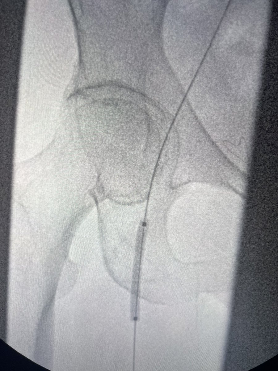 ChaconMatoso's tweet photo. 72 y/o,female, hypertensive, diabetic, with coronary disease, with femoro-popliteal bypass with great saphenous vein 2 years ago, evolving with Doppler surveillance changes and ABI drop.  performed angioplasty with drug balloon  (Stellarex). #endovascular #bypass https://t.co/pc8iTbsTFH